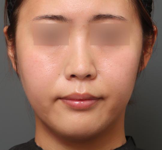 20代女性のレチノールピール After 症例写真