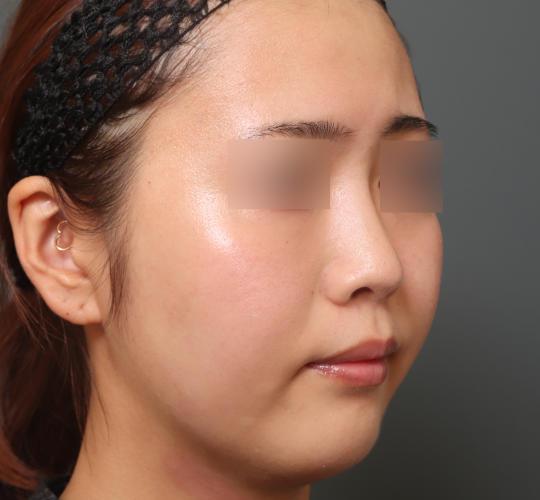 20代女性のレチノールピール After 症例写真