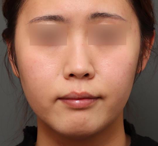 20代女性のレチノールピール Before 症例写真