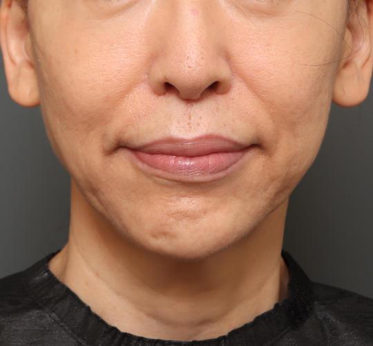 50代女性の鼻の整形 After 症例写真