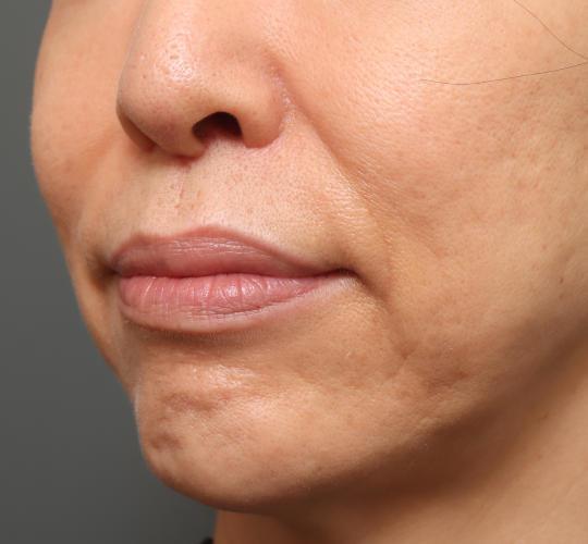 50代女性の人中短縮(リップリフト) After 症例写真