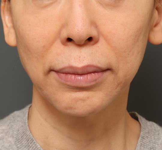 50代女性の鼻の整形 Before 症例写真