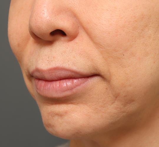 50代女性の人中短縮(リップリフト) Before 症例写真