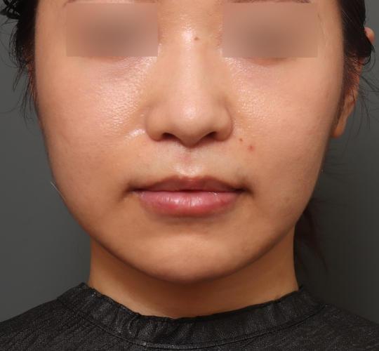 20代女性の鼻の整形 After 症例写真