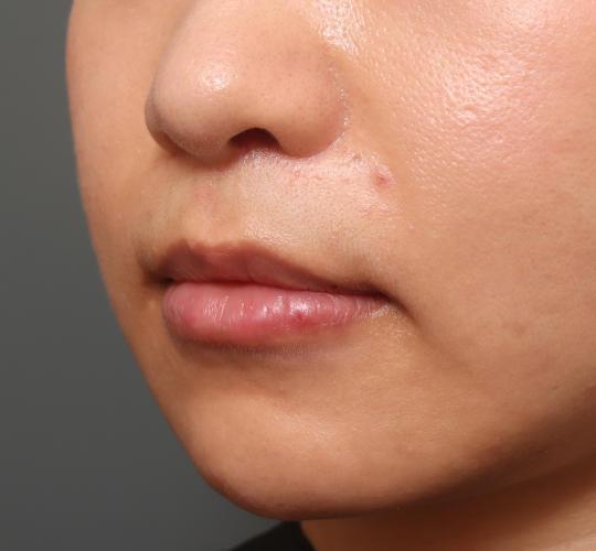 20代女性の人中短縮（リップリフト） After 症例写真