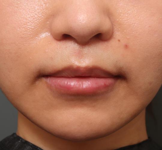 20代女性の人中短縮（リップリフト） After 症例写真