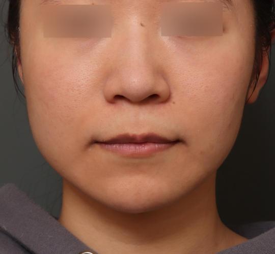 20代女性の鼻の整形 Before 症例写真