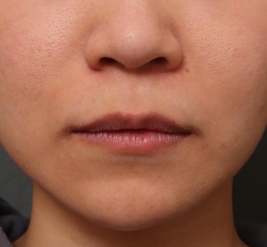 20代女性の人中短縮（リップリフト） Before 症例写真