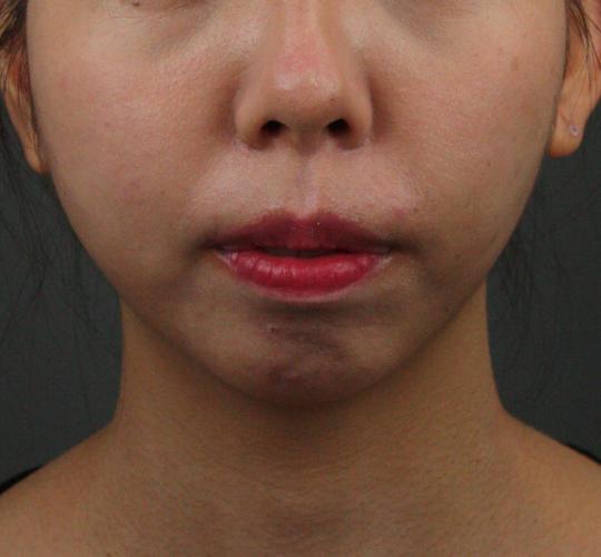 20代女性の唾液腺ボトックス After 症例写真