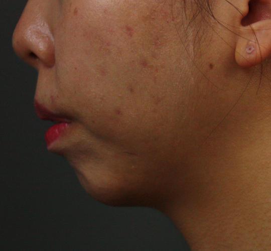 20代女性の唾液腺ボトックス After 症例写真