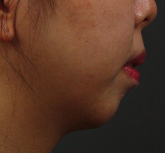 20代女性の唾液腺ボトックス注射 After 症例写真