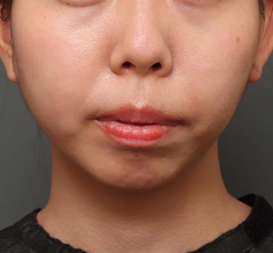 20代女性の唾液腺ボトックス Before 症例写真