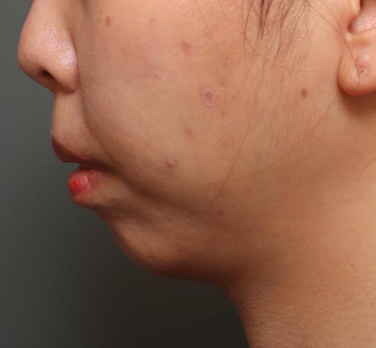 20代女性の唾液腺ボトックス Before 症例写真