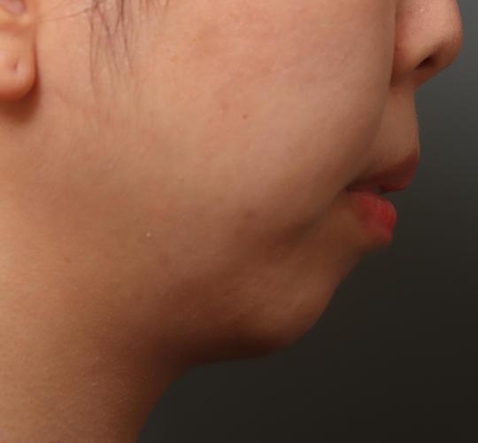 20代女性の唾液腺ボトックス注射 Before 症例写真