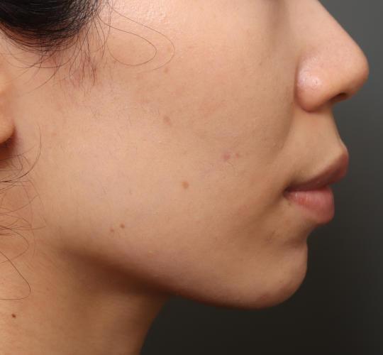 20代女性の唾液腺ボトックス注射 After 症例写真