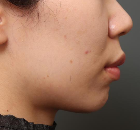 20代女性の唾液腺ボトックス注射 Before 症例写真