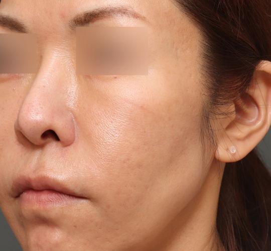 40代女性のヴァンパイアフェイシャル After 症例写真