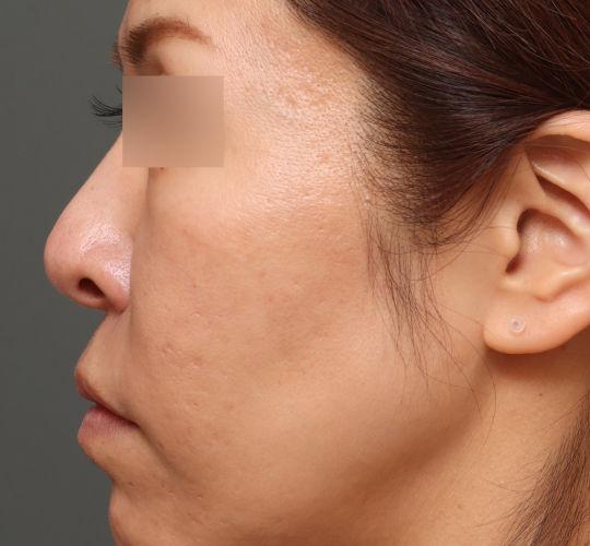 40代女性のヴァンパイアフェイシャル After 症例写真