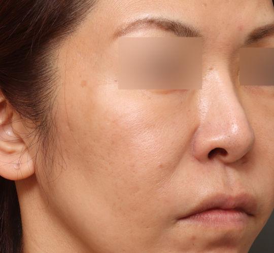40代女性の毛穴・黒ずみ After 症例写真