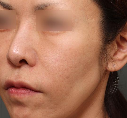 40代女性のヴァンパイアフェイシャル Before 症例写真