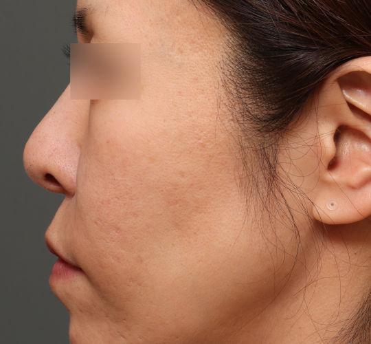 40代女性のヴァンパイアフェイシャル Before 症例写真