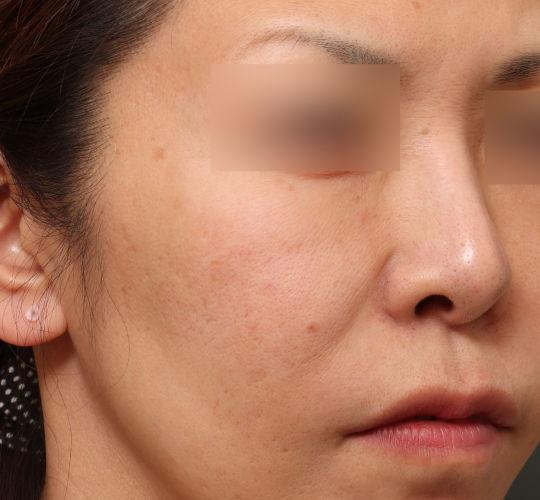 40代女性の毛穴・黒ずみ Before 症例写真