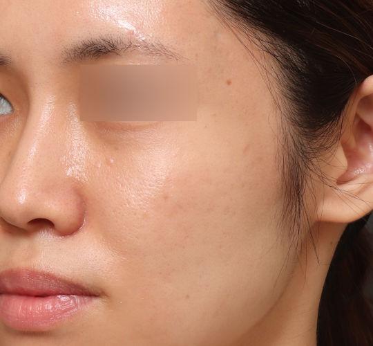 20代女性のヴァンパイアフェイシャル After 症例写真