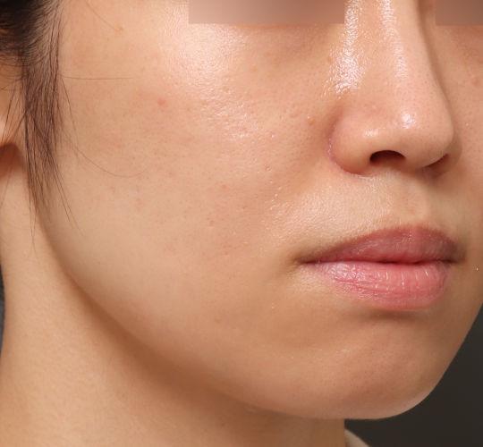20代女性の毛穴・黒ずみ After 症例写真