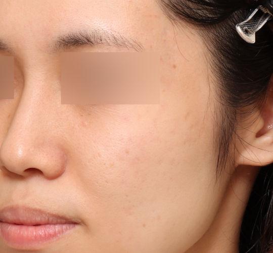 20代女性のヴァンパイアフェイシャル Before 症例写真