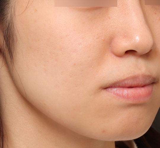 20代女性の毛穴・黒ずみ Before 症例写真