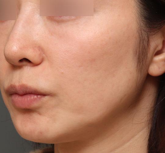 40代女性の毛穴・黒ずみ After 症例写真