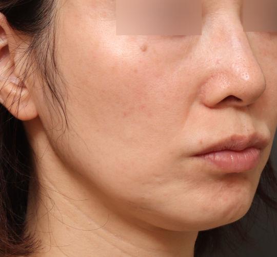 40代女性のヴァンパイアフェイシャル After 症例写真