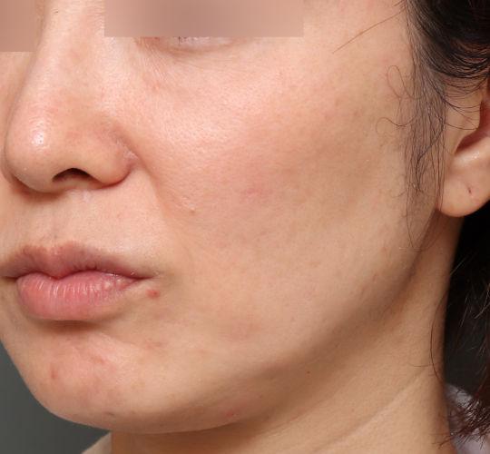 40代女性の毛穴・黒ずみ Before 症例写真