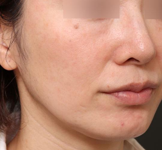 40代女性のヴァンパイアフェイシャル Before 症例写真