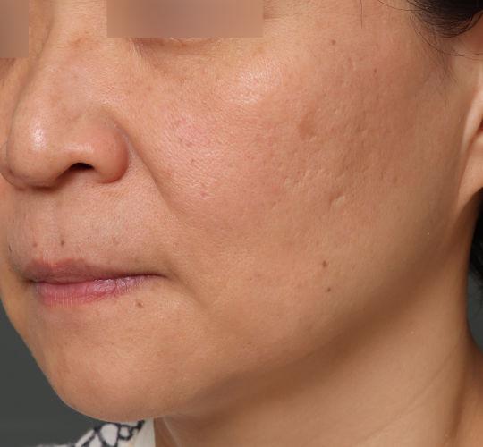 40代女性のヴァンパイアフェイシャル After 症例写真