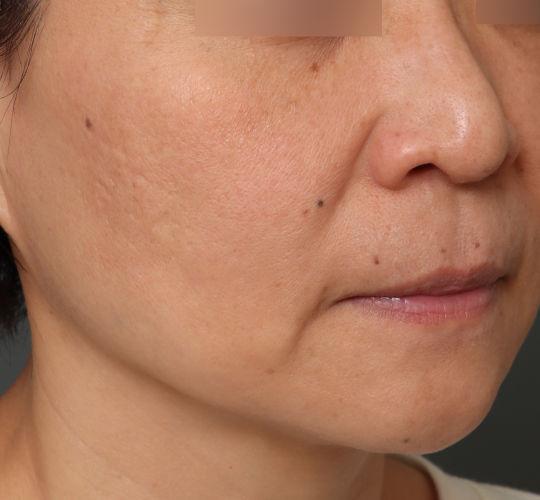 40代女性の毛穴・黒ずみ After 症例写真