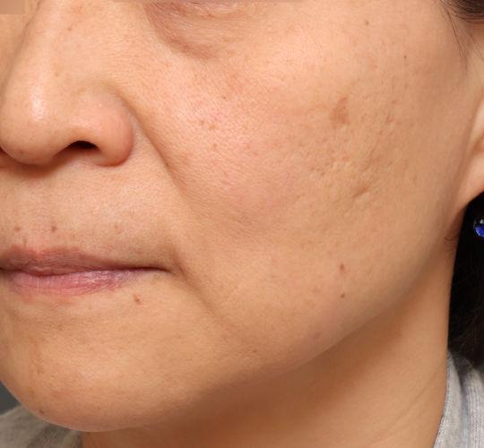 40代女性のヴァンパイアフェイシャル Before 症例写真