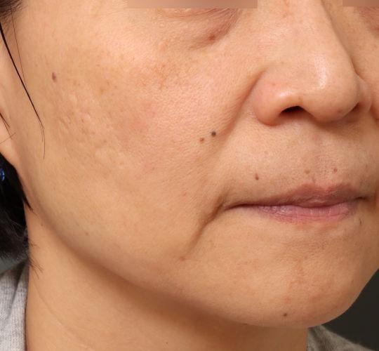 40代女性の毛穴・黒ずみ Before 症例写真