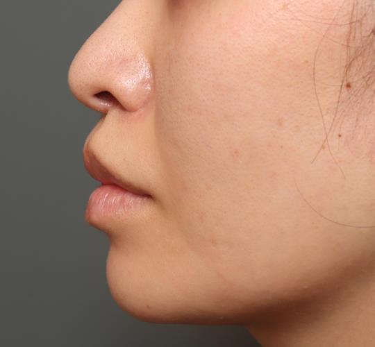 30代女性のメーラーファット除去 After 症例写真