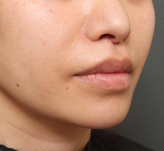 30代女性のメーラーファット除去 After 症例写真