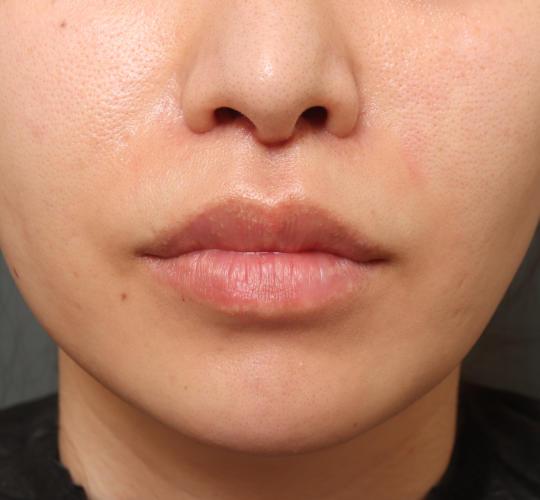 30代女性のメーラーファット除去 After 症例写真