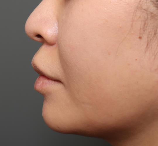 30代女性のメーラーファット除去 Before 症例写真