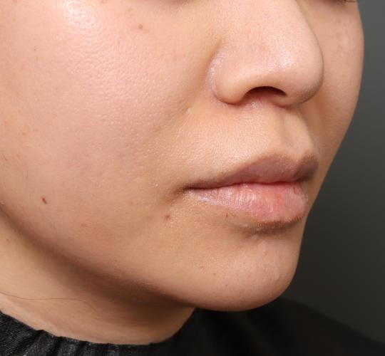 30代女性のメーラーファット除去 Before 症例写真