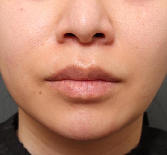 30代女性のメーラーファット除去 Before 症例写真