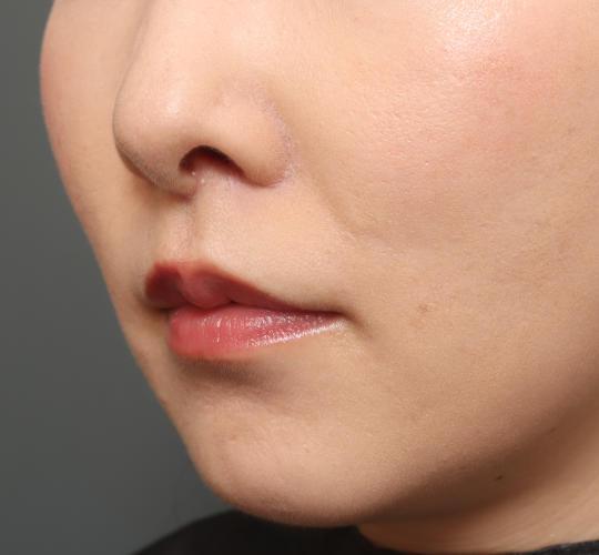 30代女性の人中短縮（リップリフト） After 症例写真