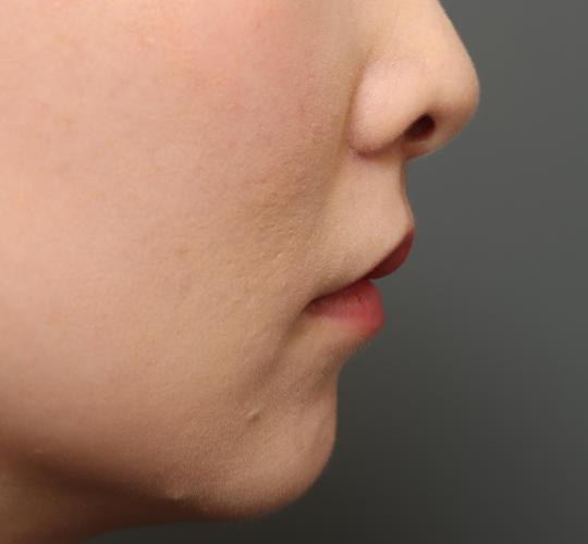 30代女性の人中短縮（リップリフト） After 症例写真