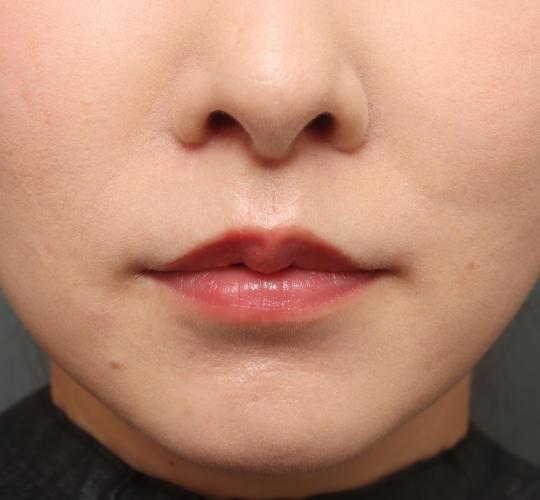 30代女性の人中短縮（リップリフト） After 症例写真