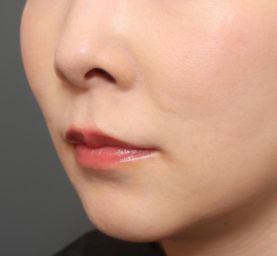 30代女性の人中短縮（リップリフト） Before 症例写真