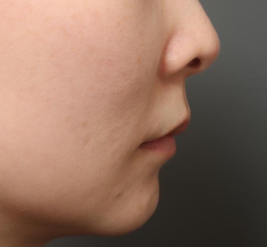 30代女性の人中短縮（リップリフト） Before 症例写真