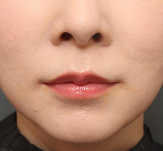 30代女性の人中短縮（リップリフト） Before 症例写真